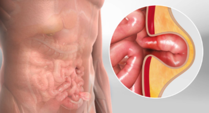 Advanced Hernia Treatment in Chennai at S A Hos... main image