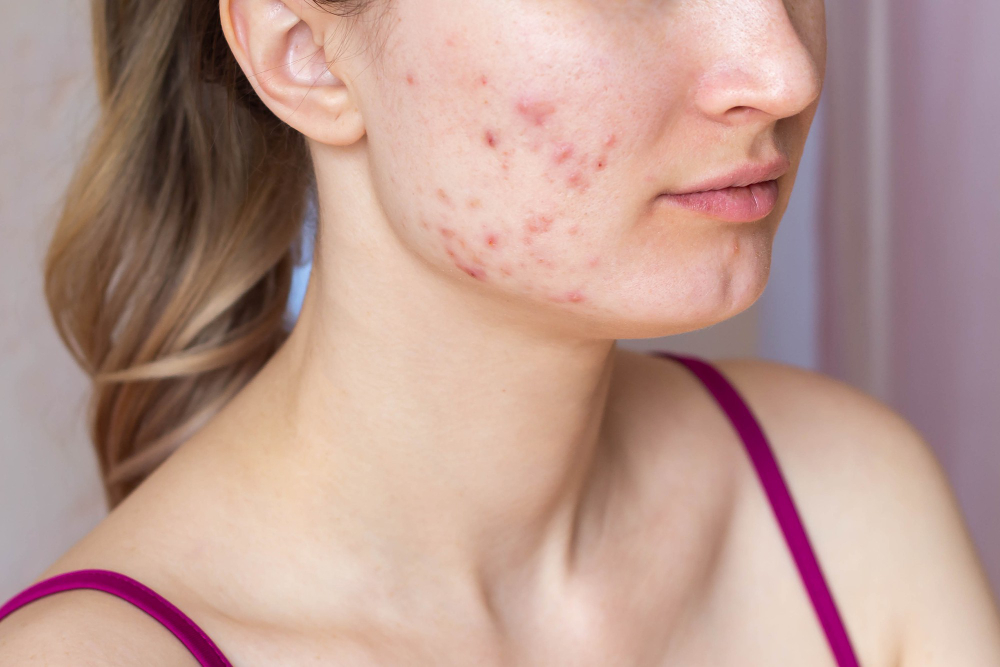 Acne and Acne Scars Treatment in Bishop Garden – S... main image