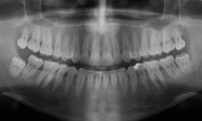 OPG (Dental Imaging)