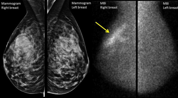 Mammography in Gurugram – Early Detection for B... main image