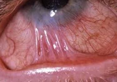 Symblepharon Treatment in Nagpur – Advanced Eye... main image