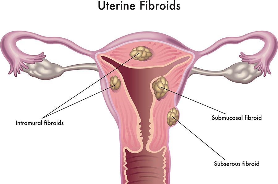 Fibroid Uterus Treatment in Nagpur: Effective S... main image