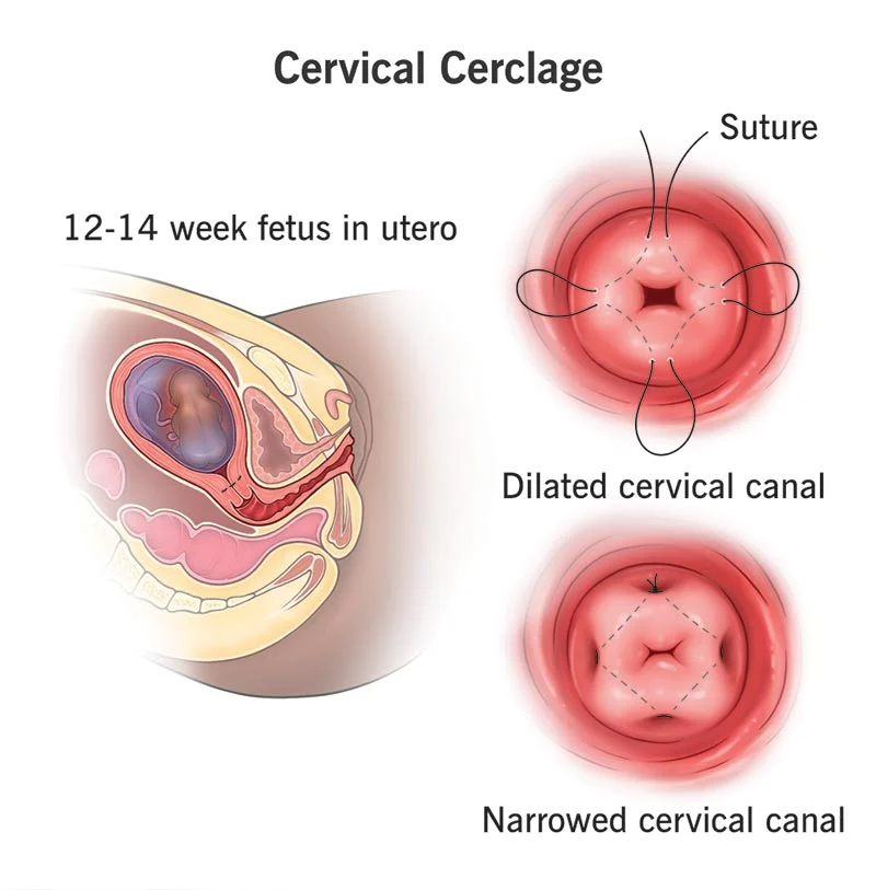 Cervical Cerclage in Nagpur: Protecting Your Pregn... main image