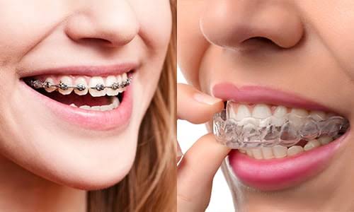Best Aligners & Braces Treatment in Jaipur – Pa... main image