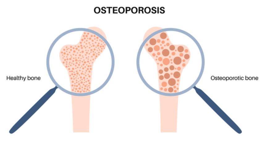 Best Osteoporotic Management in Nagpur – Advanc... main image