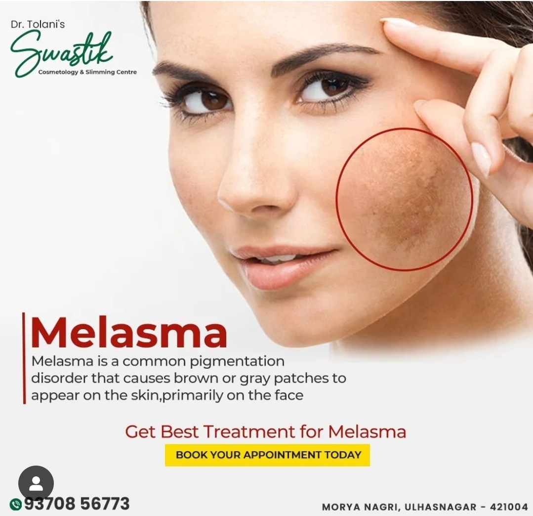 Most Commonly Searched Queries on Melasma
Looking ... main image