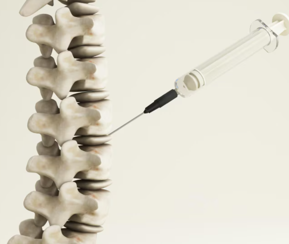 Best Vertebroplasty and Kyphoplasty Treatment i... main image