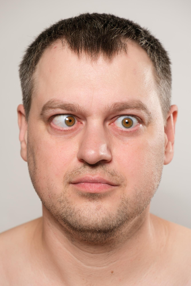 Squint Treatment in Nagpur – Correct Misaligned... main image