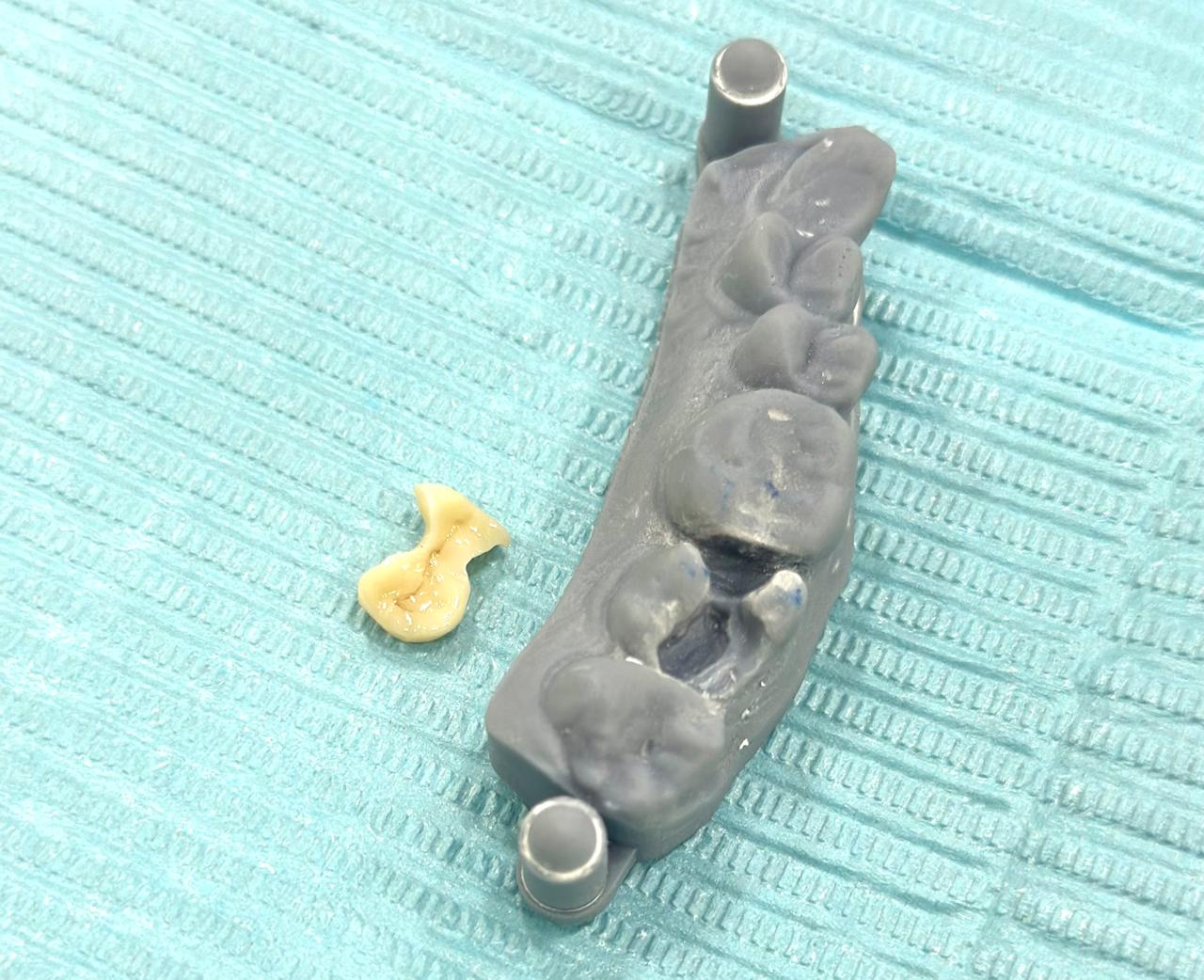 Does your dental fillings keeps breaking or chi... main image