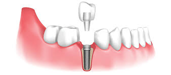 Best Dental Implant in Jaipur – Paras Dental Ca... main image