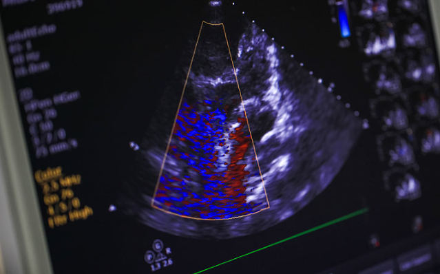 Echocardiogram in Gu