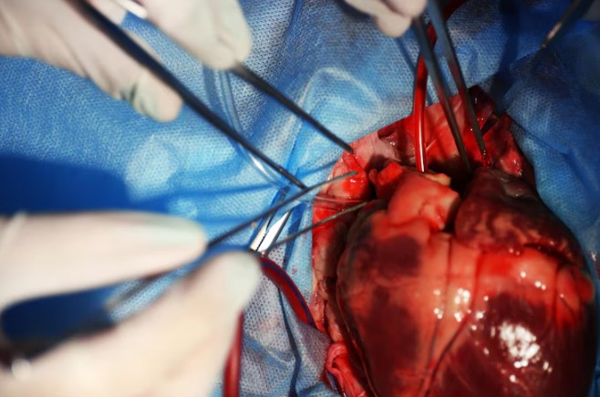 Beating Heart Bypass Surgery in Nagpur Beating Hea... main image