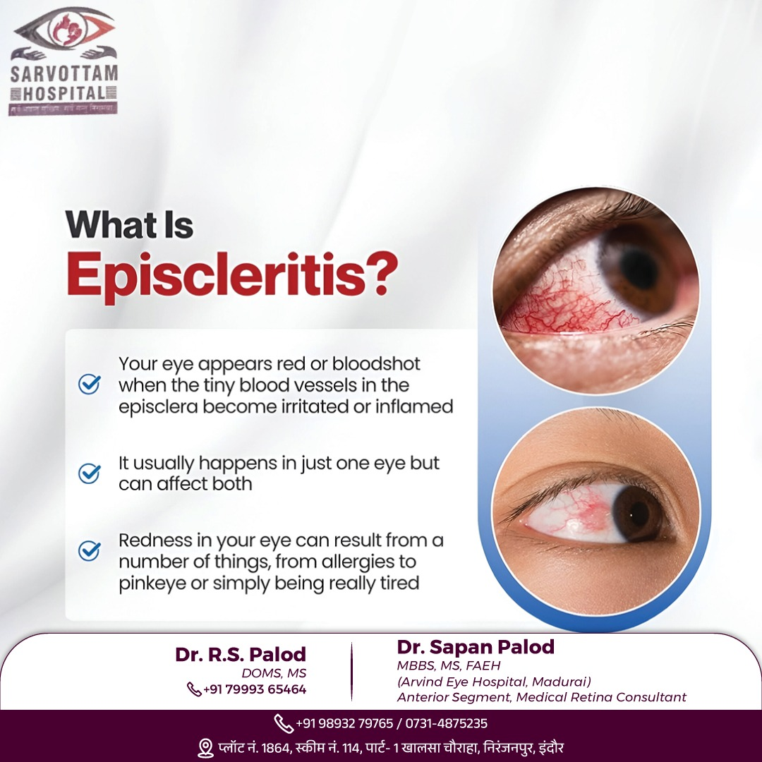 Episcleritis is a condition characterized by infla... main image
