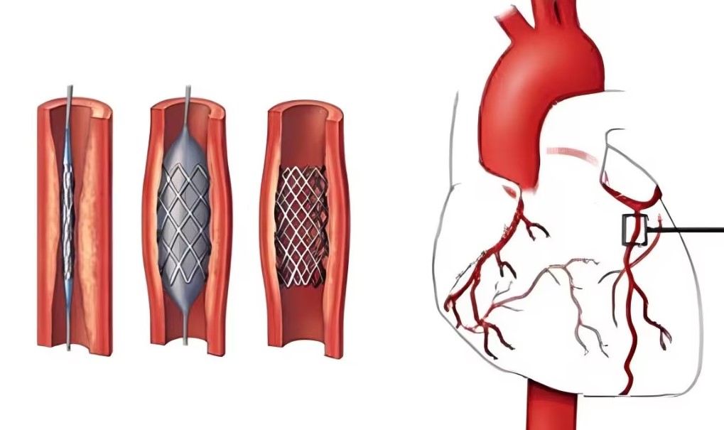 Completion Angiography in Nagpur Completion Ang... main image