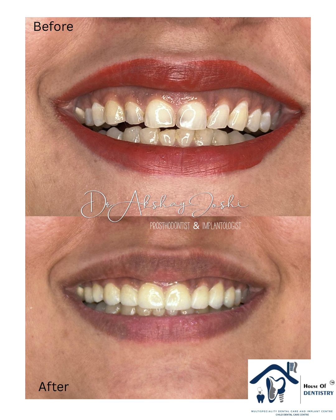 Dental veneers for smile makeover! 

#Prosthodo... main image