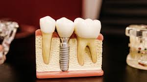 Best Root Canal Treatment (RCT) at Paras Dental... main image