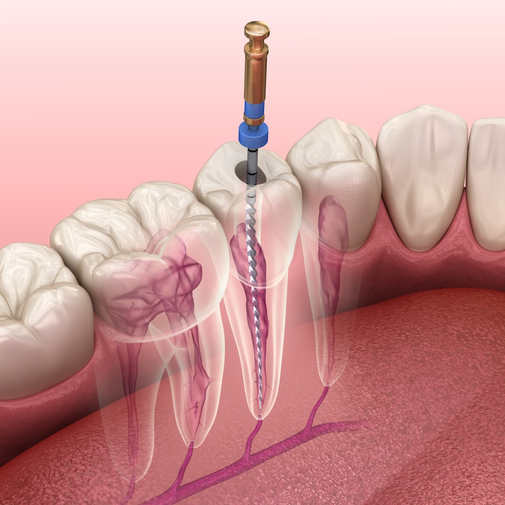 Root Canal Treatment in Nashik – Painless & Adv... main image