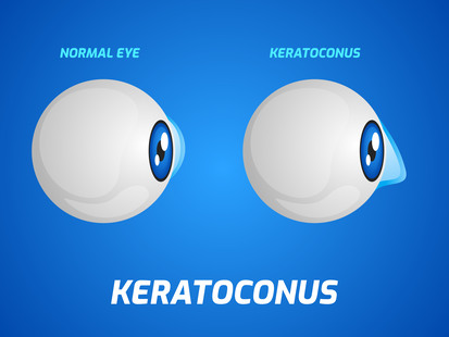 Keratoconus Treatment in Nagpur – Strengthen Yo... main image