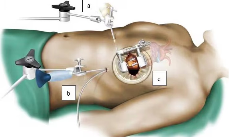 MICS CABG in Nagpur Minimally Invasive Coronary... main image