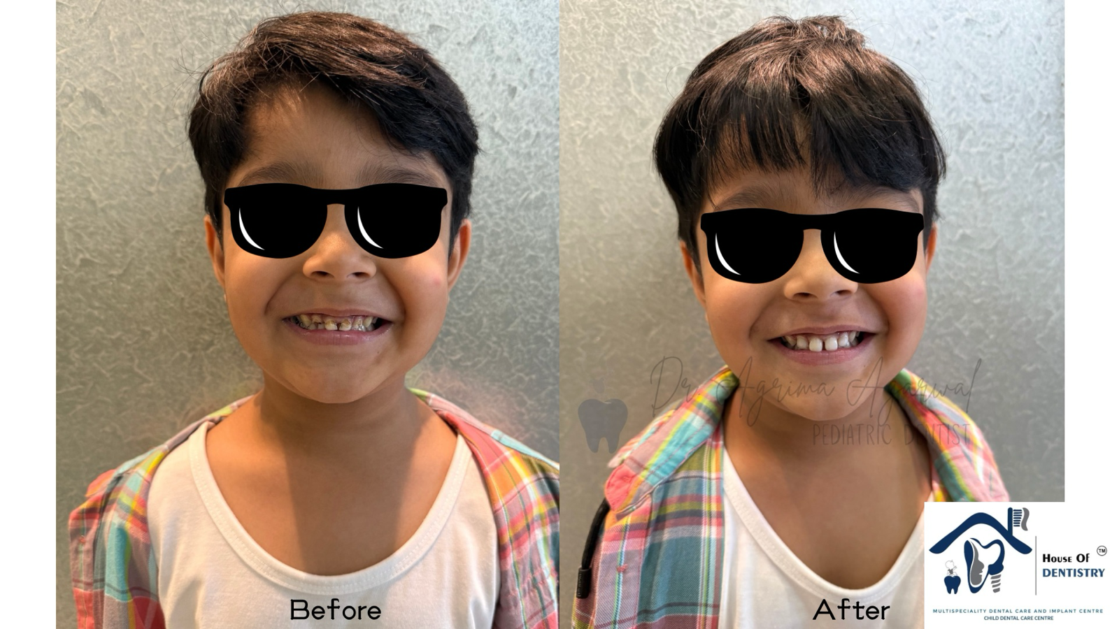 Smile restoration for our little champ! 

#Kids... main image