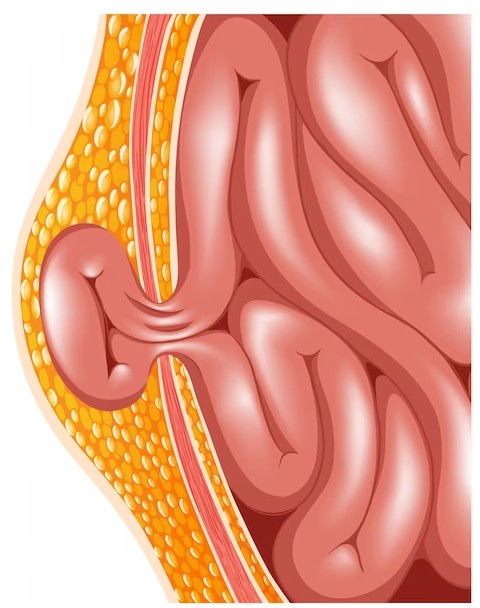 Hernia Surgery Hospital in Pune Hernia surgery ... main image