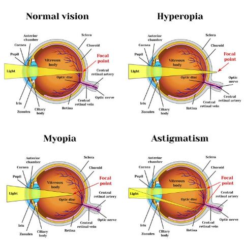 Refractive Error Correction in Nagpur – Clearer... main image