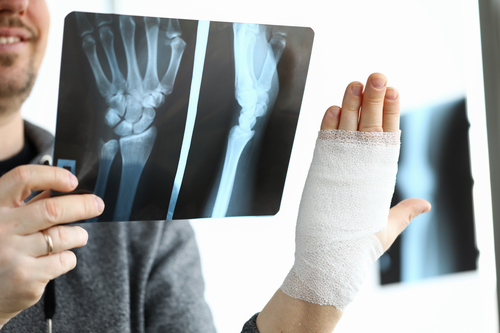 Best Bone Fracture Treatment in Chennai at KC H... main image