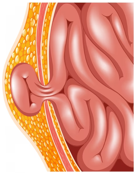 Advanced Hernia Treatment in Chennai for Quick ... main image