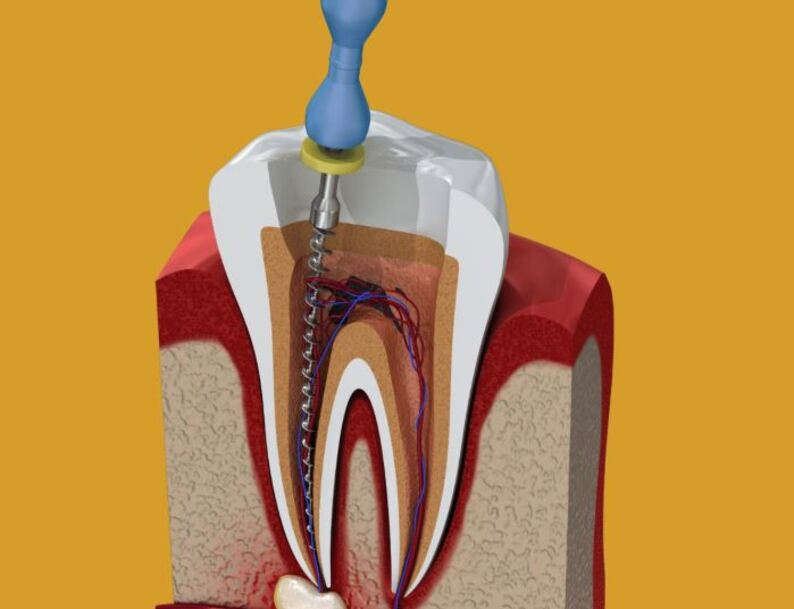 Best Root Canal Specialist in Nagpur – Painless... main image