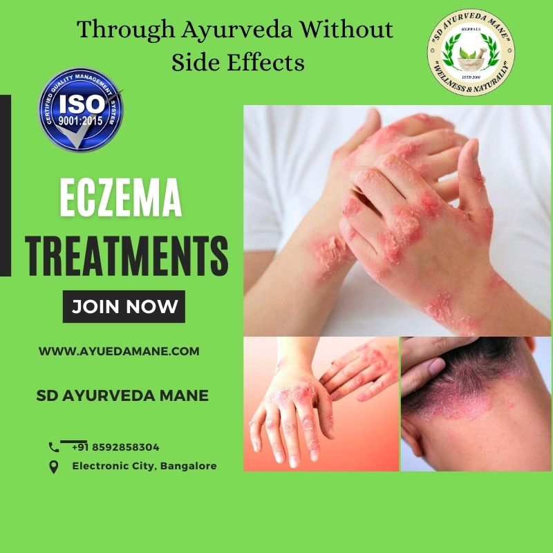 Ayurvedic Eczema Treatment in Electronic City, Ban... main image
