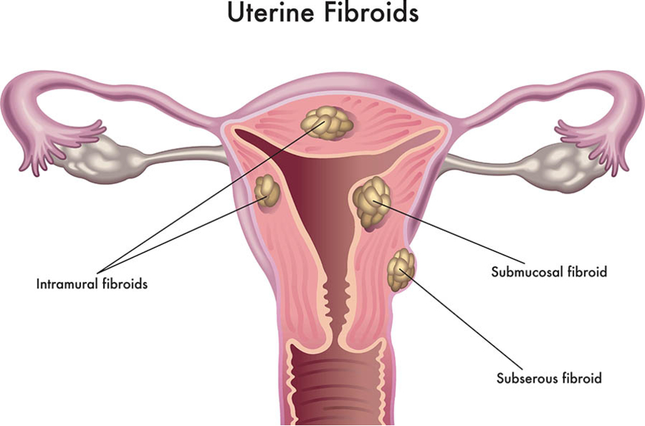 Fibroid Uterus Treatment in Nagpur – Effective Sol... main image