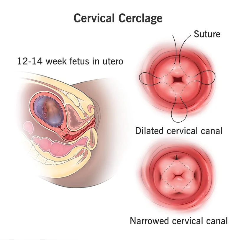 Cervical Cerclage in Nagpur – Preventing Preterm B... main image
