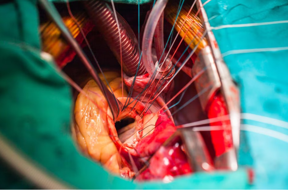 OPCAB in Nagpur Off-Pump Coronary Artery Bypass... main image