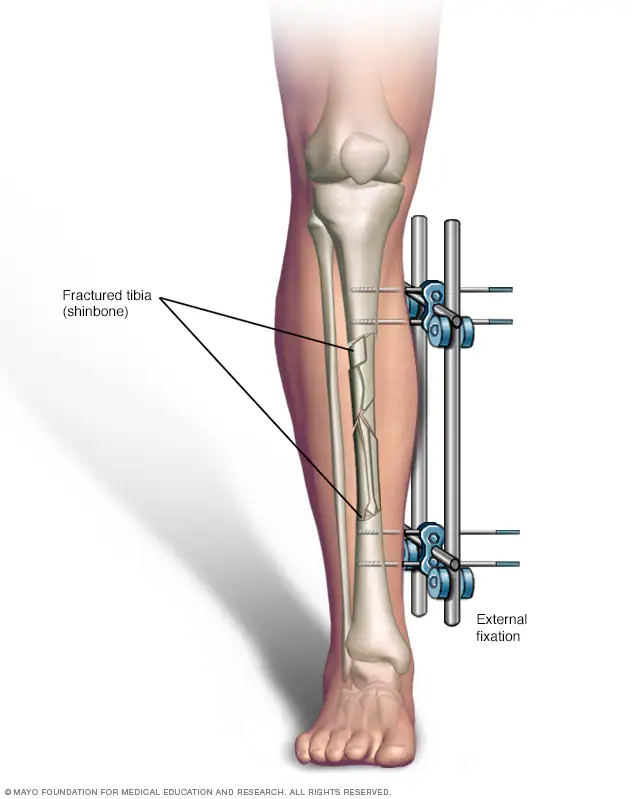 Surgical Fixation of Fractures in Nashik Road, ... main image