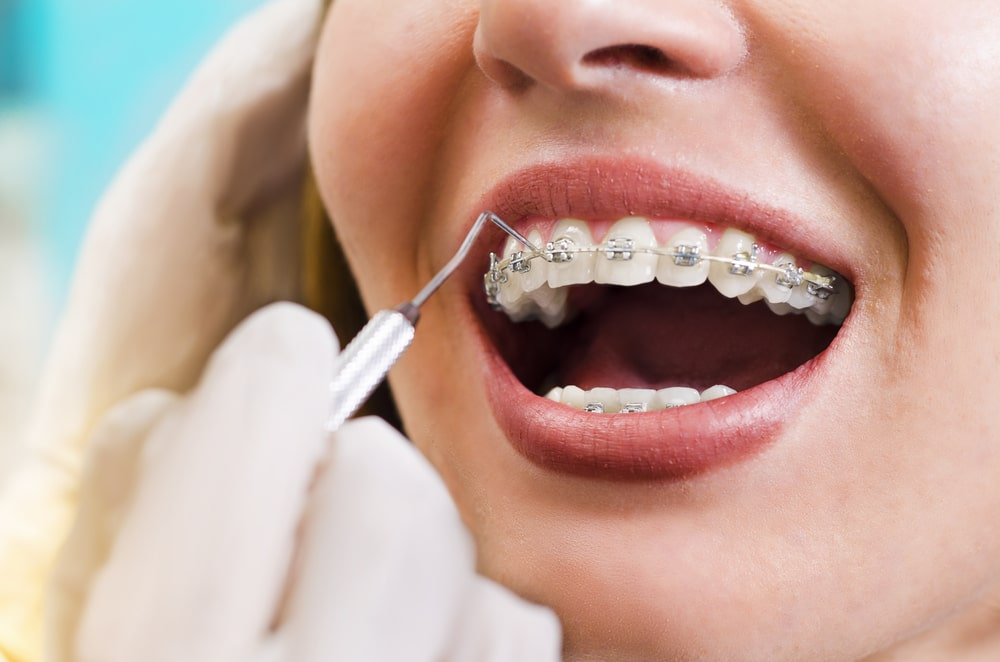 Braces Treatment in Pathardi Phata, Nashik We p... main image