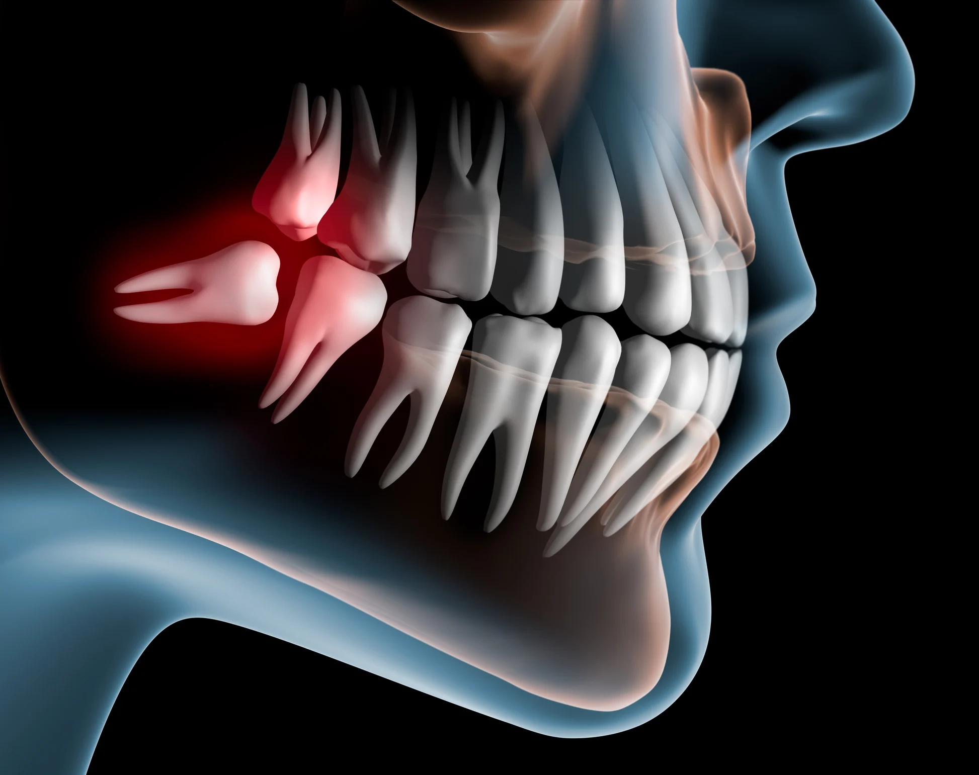 Tooth & Third Molar Extraction in Pathardi Phata, ... main image