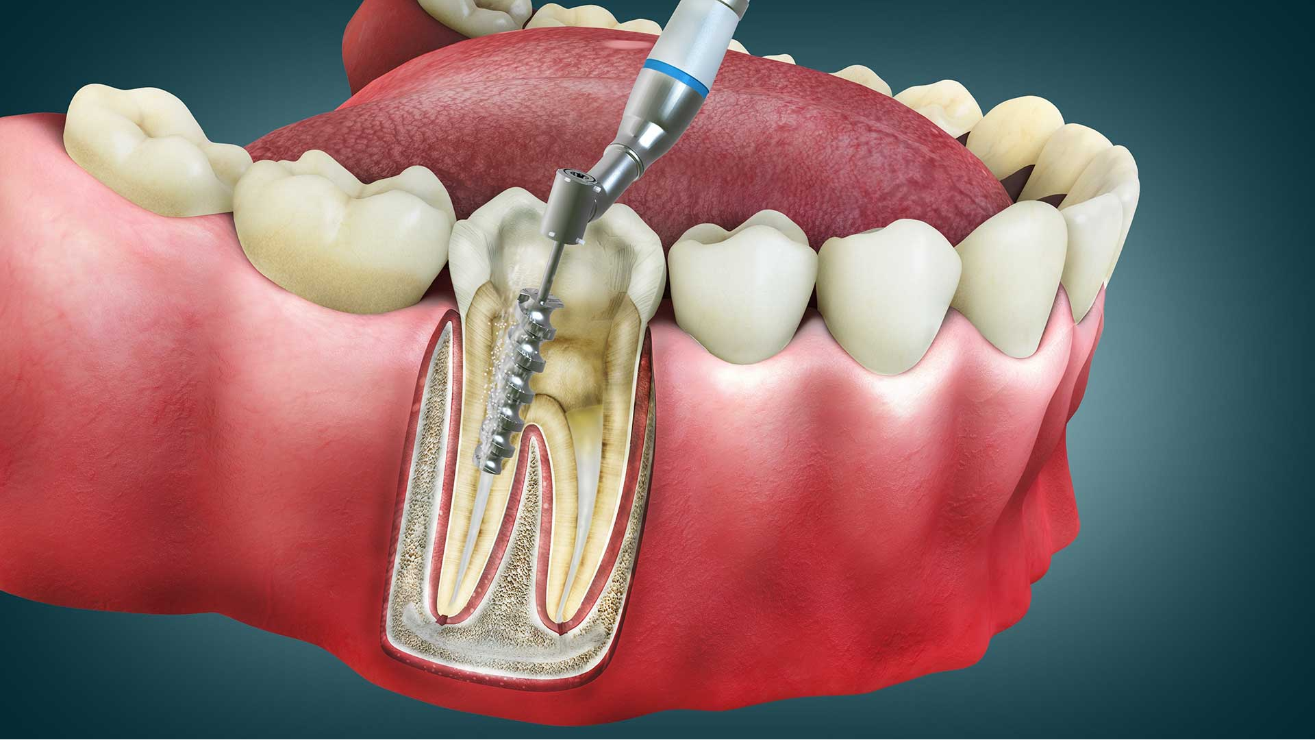 Root Canal Treatment in Pathardi Phata, Nashik ... main image