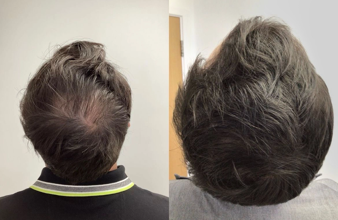 Hair Fall / Hair Growth Treatment in Pathardi Phat... main image