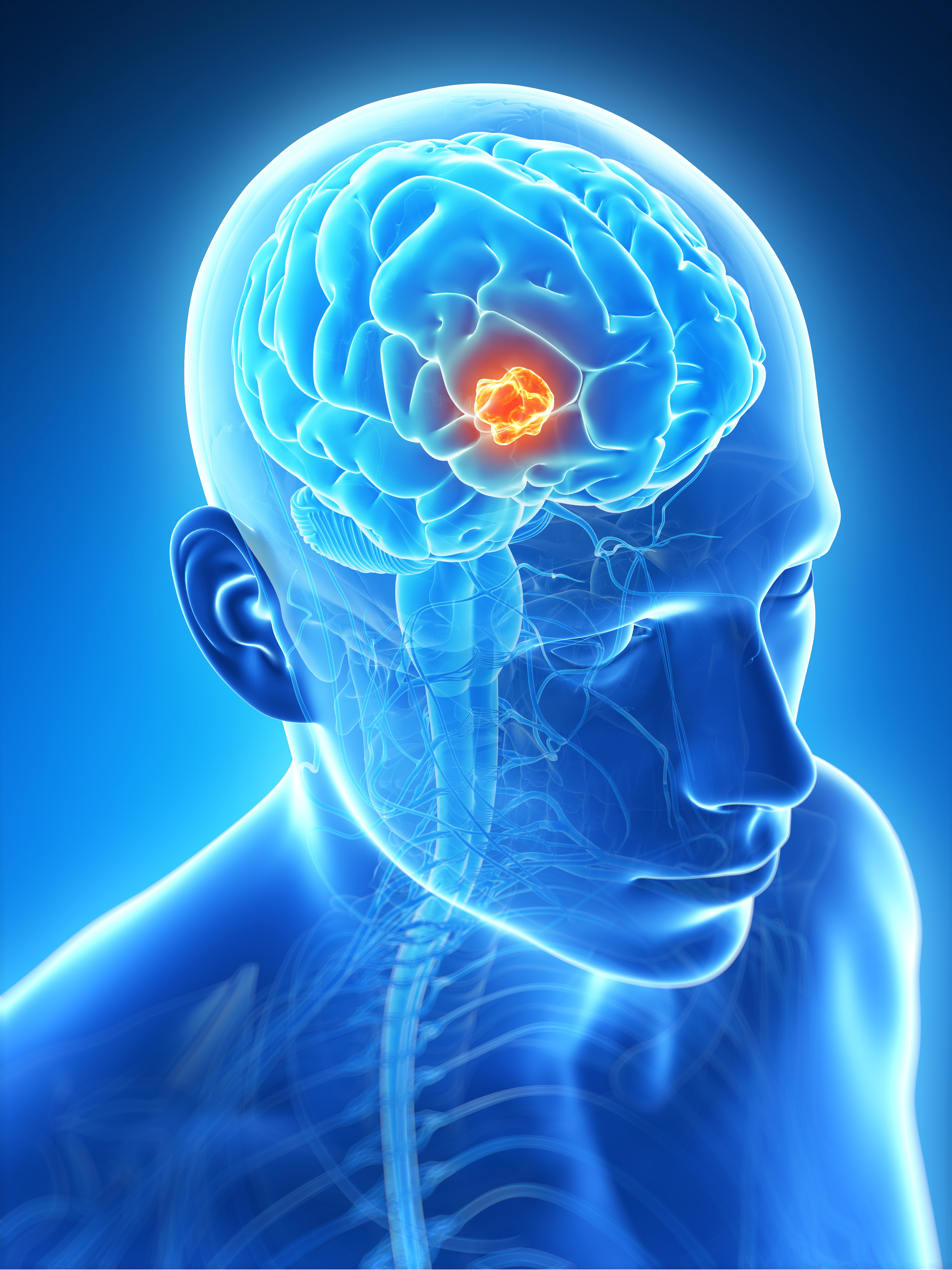 Best Surgeon for Brain Tumor in Jaipur: Excellence... main image