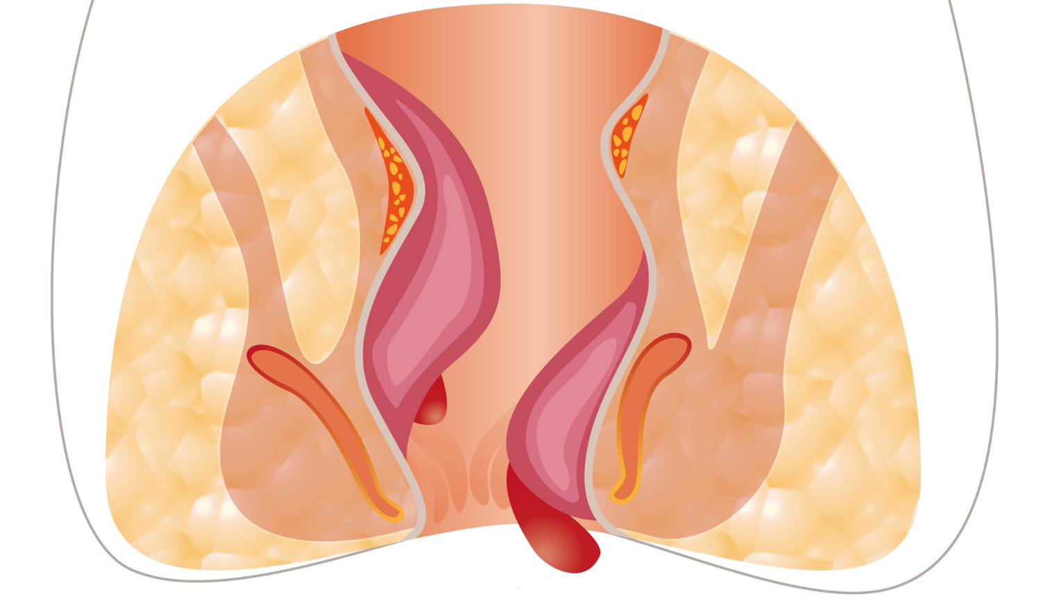 Fistula Clinic in Velachery – Specialised Treat... main image