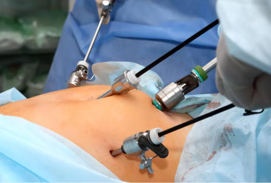 Laparoscopic Hysterectomy in Chennai – Safe and... main image