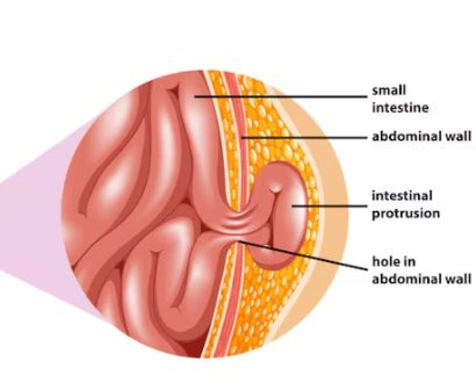 Hernia Clinic in Adambakkam – Expert Hernia Tre... main image