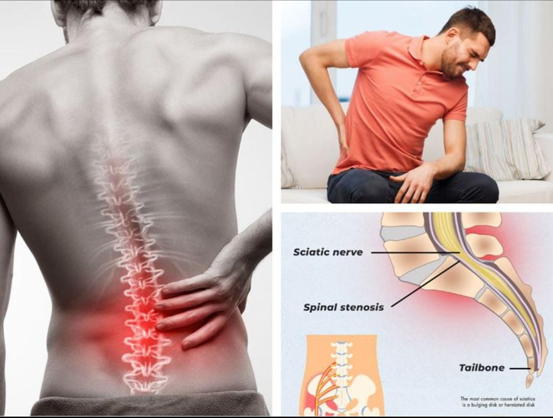 *Sciatica: The Pain That Travels – Find Natural Re... main image