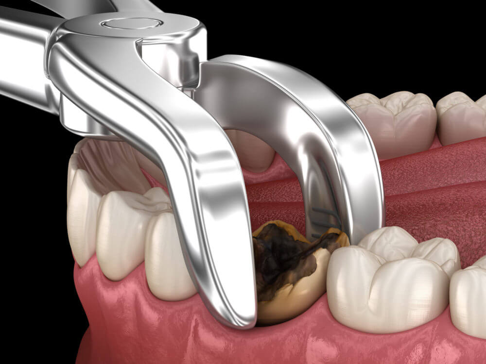 Need a painless tooth extraction in Nashik ? Vi... main image
