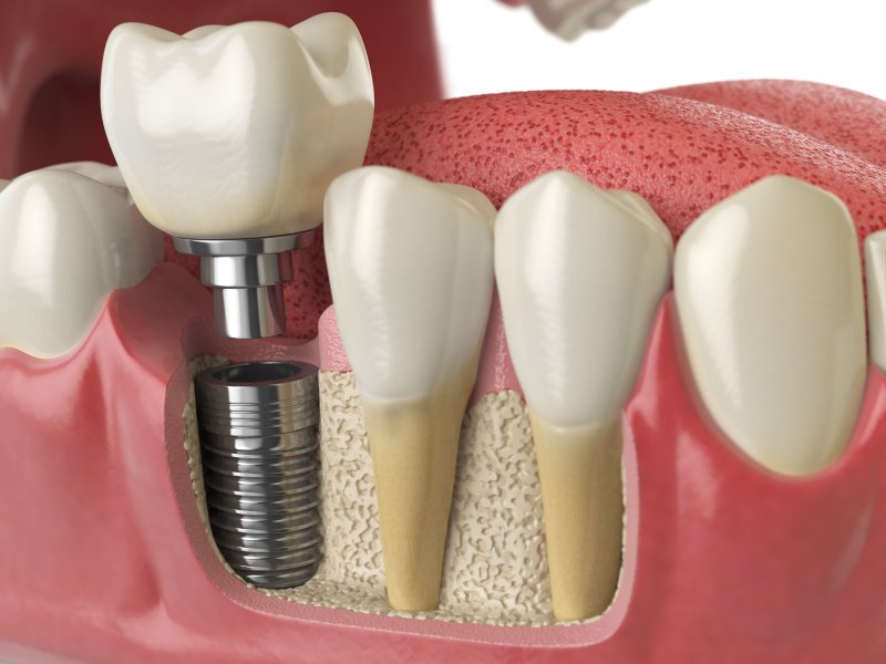 Looking for permanent tooth replacement in Nash... main image