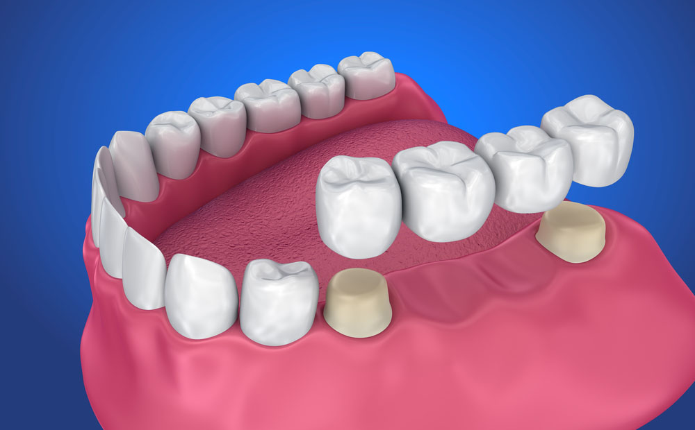 Enhance your smile with custom-made dental crow... main image