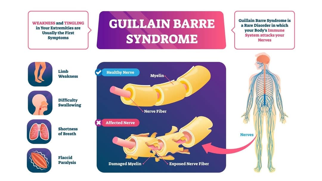 Guillain-Barré Syndrome (GBS) is a rare neurologic... main image