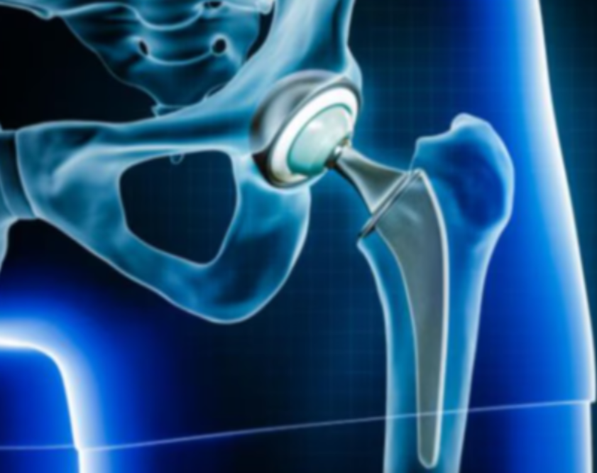 Best Hip Replacement Surgery in Chennai at KC H... main image