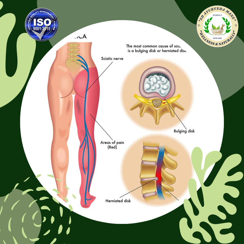 Back Pain and Spondylosis Treatment at SD Ayurv... main image
