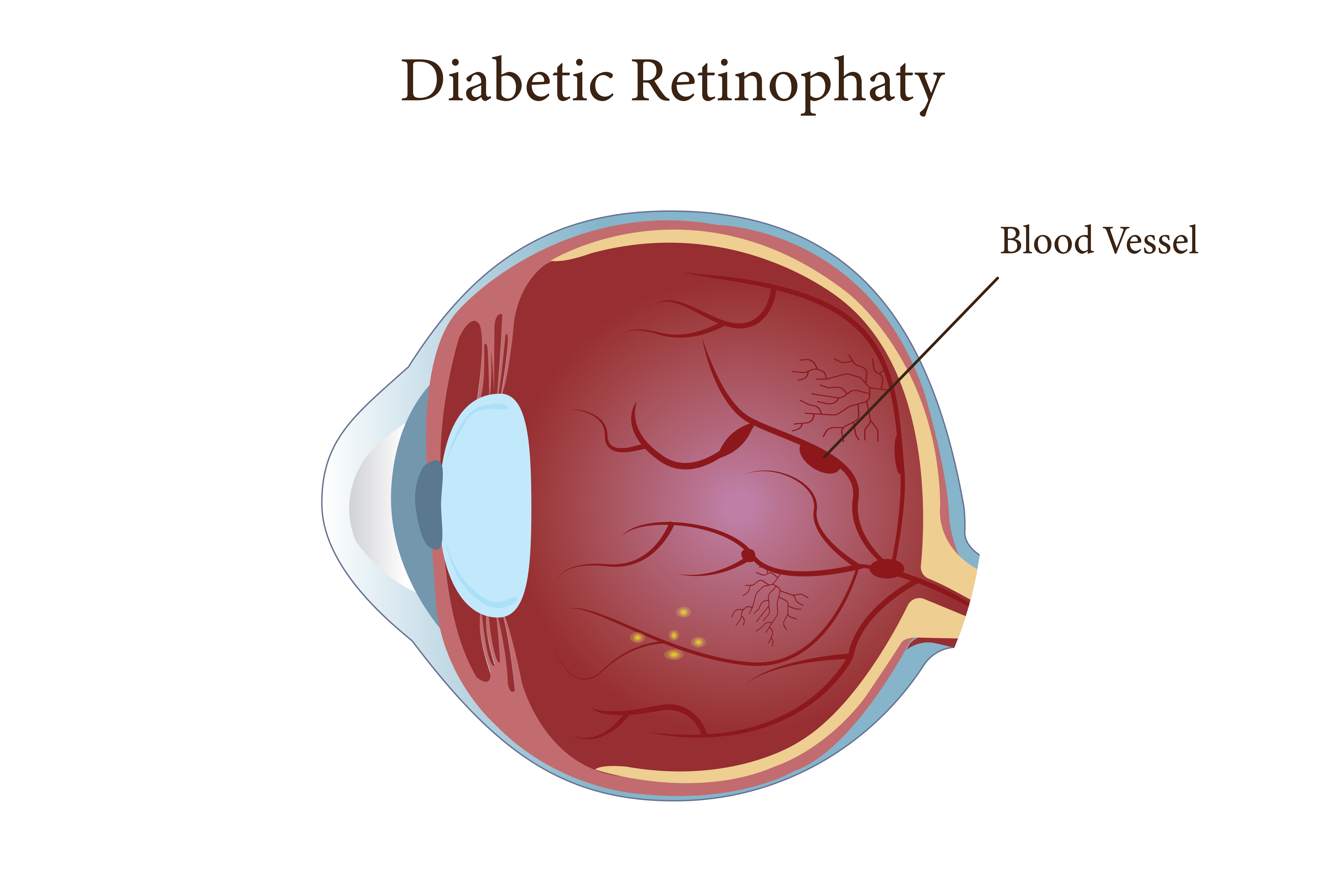 Diabetic Retinopathy Treatment in Nagpur – Protect... main image